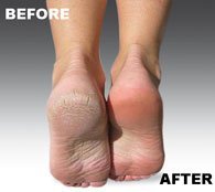 Genuine Emjoi Micro-Pedi Refill Rollers (Extra Coarse) by Emjoi