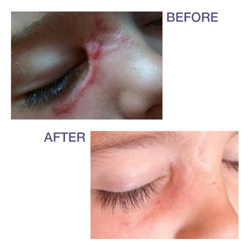 Pro-Sil SPF (Pro-Sil Sport) Patented Silicone Scar Treatment Stick w/Sunscreen (SPF 15) - Clinically Proven to Reduce the Appear