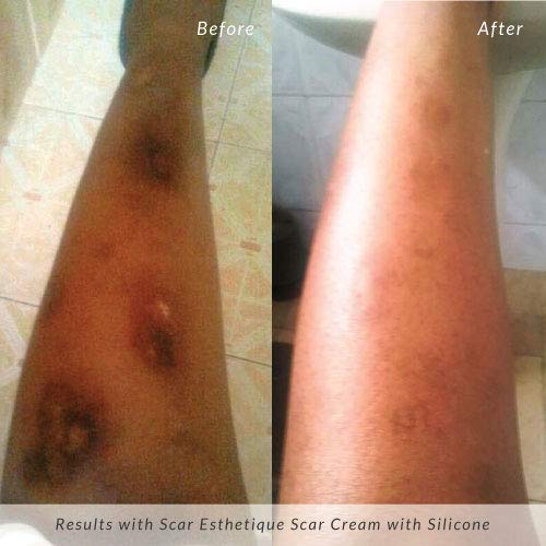 Rejuvaskin Scar Esthetique Scar Cream with Silicone - Scar Cream For Surgical Scars, Stretch Marks, Keloids, Acne, C-section, an