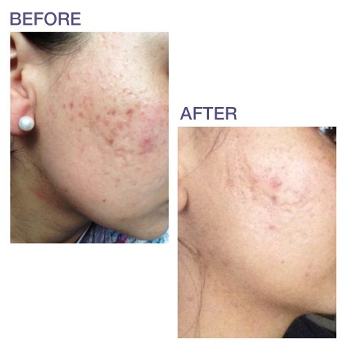 Pro-Sil SPF (Pro-Sil Sport) Patented Silicone Scar Treatment Stick w/Sunscreen (SPF 15) - Clinically Proven to Reduce the Appear