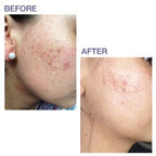 Pro-Sil SPF (Pro-Sil Sport) Patented Silicone Scar Treatment Stick w/Sunscreen (SPF 15) - Clinically Proven to Reduce the Appear