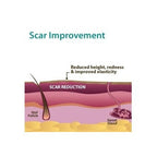 Epi-Derm Epi-Tabs (6) (Clear Circles) Silicone Scar Sheets from Biodermis