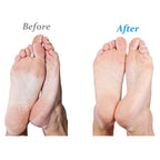 Emjoi Micro-Pedi Battery Operated Callus Remover