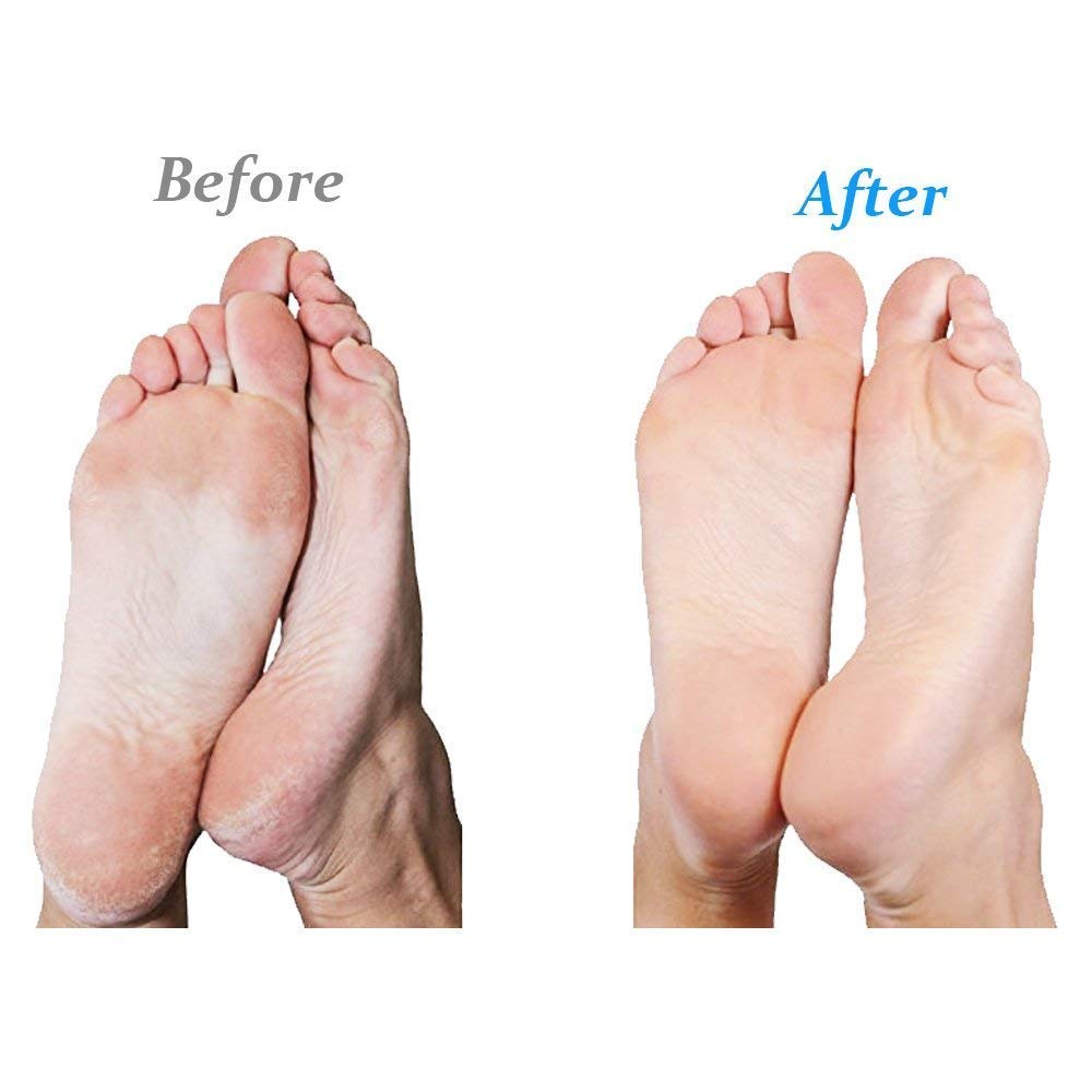 Emjoi Micro-Pedi Callus Remover (Lilac)