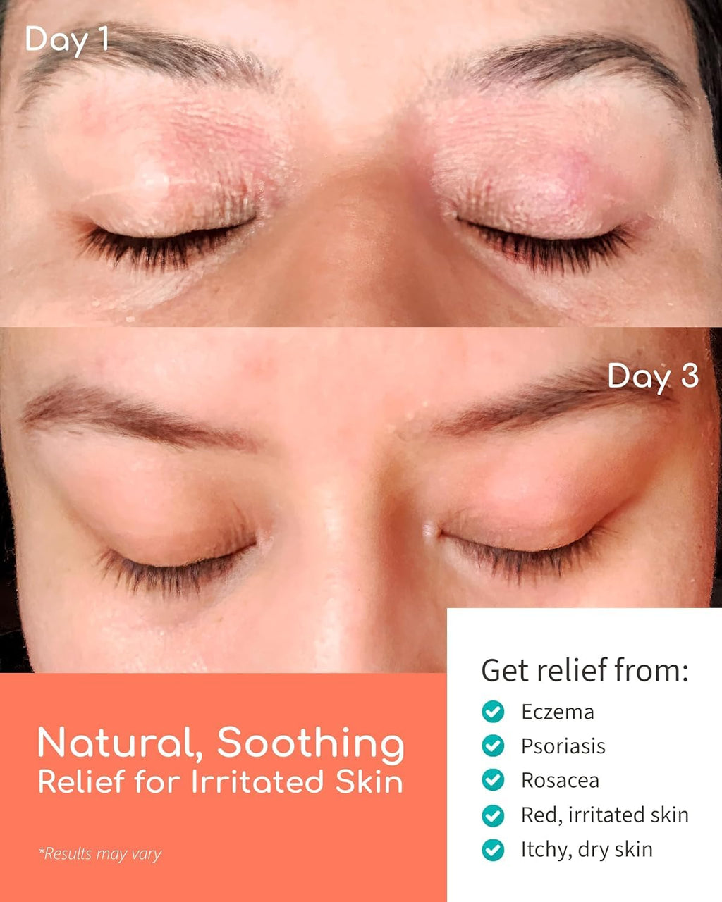 Nourish + Hydrate Manuka Balm - New Skin Soothing Cream for Sensitive Dry Skin, Made in USA, Honey Eczema Relief, Natural Psoria