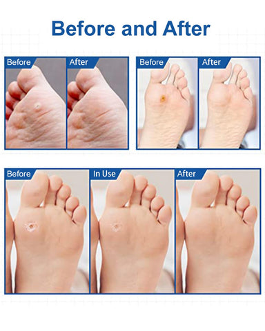 MYMULIKE 48Pcs Corn Removers for Toes & Feet, Tackle Tough Corns with Ease, 0.4 Diameter Large Size, Experience Quick Recover wi