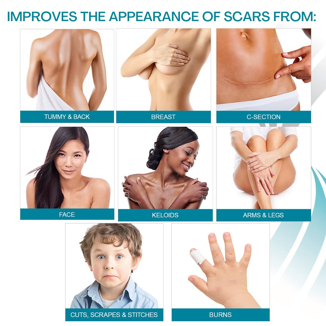 NewGel+E Advanced Silicone Scar Treatment Gel for Old and New Scars w Vitamin E, for Surgery, Injury, Keloids, Burns, and Facial