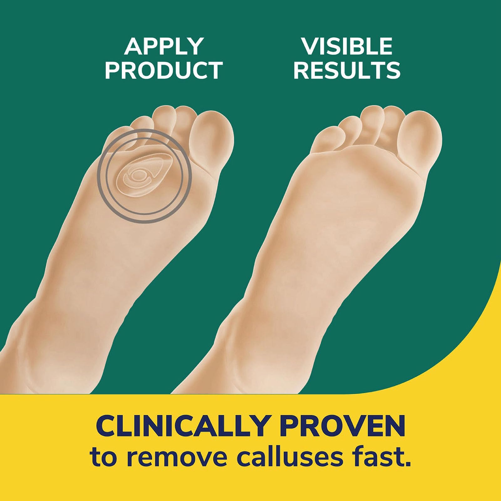 Dr. Scholl's CALLUS REMOVER Seal & Heal Bandage with Hydrogel Technology, 4ct // Removes Calluses Fast And Provides Cushioning P