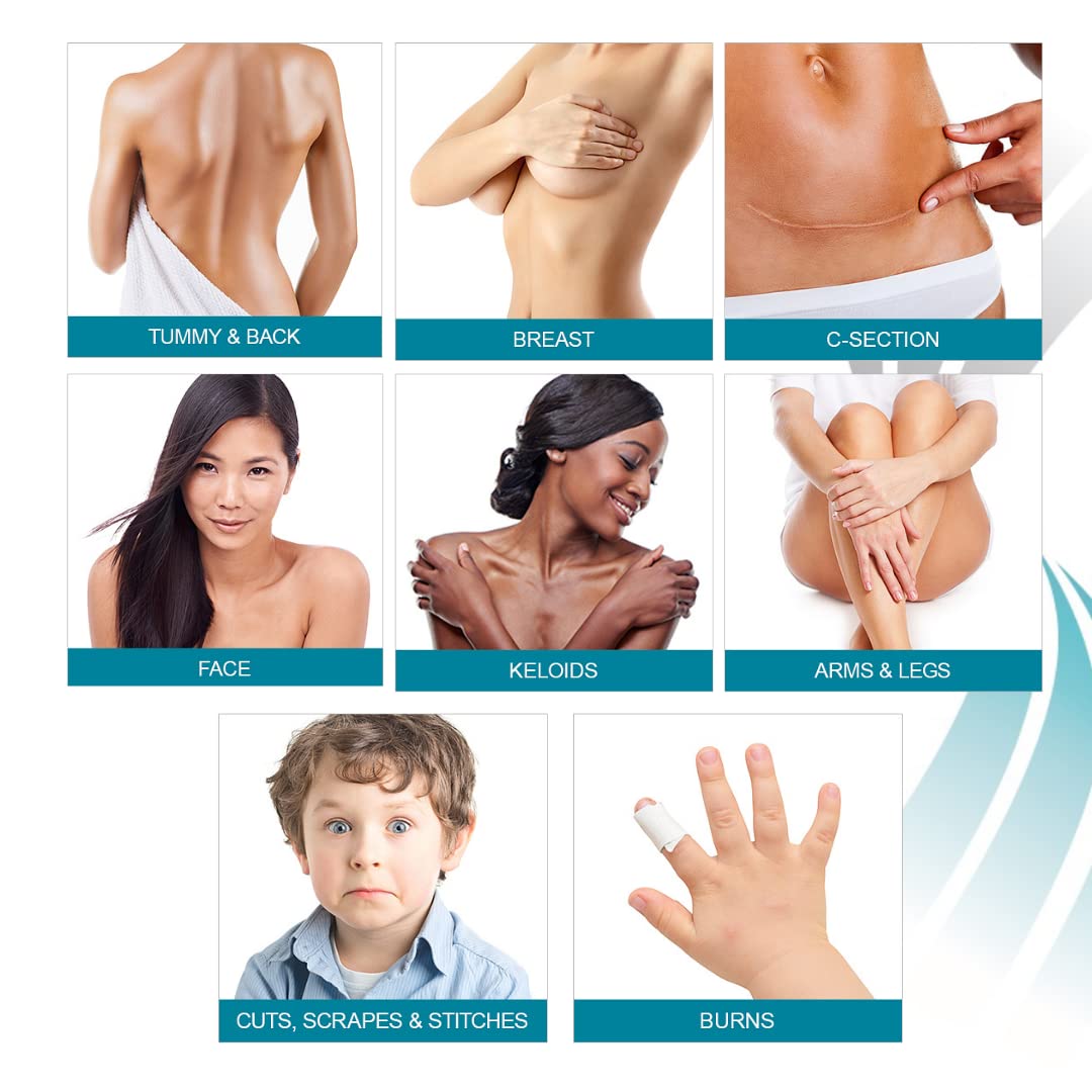 NewGel+ Advanced Silicone Professional Scar Treatment Tape for Abdomen and Extremity, Post Surgery, C-Section, Injury, Keloids,