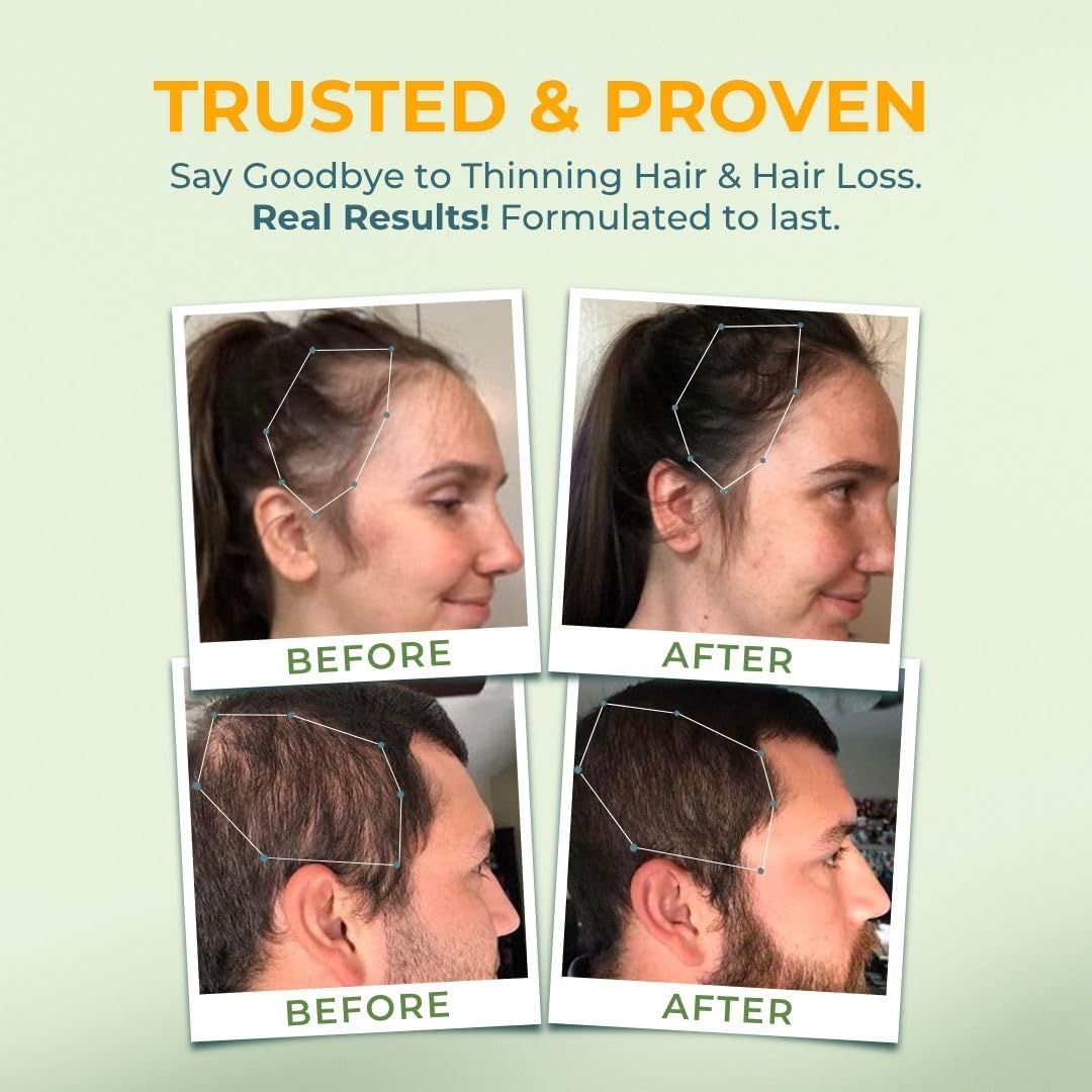 Vitalyra Biotin & B-Complex Hair Vitamins - Hair, Skin & Nails Supplement