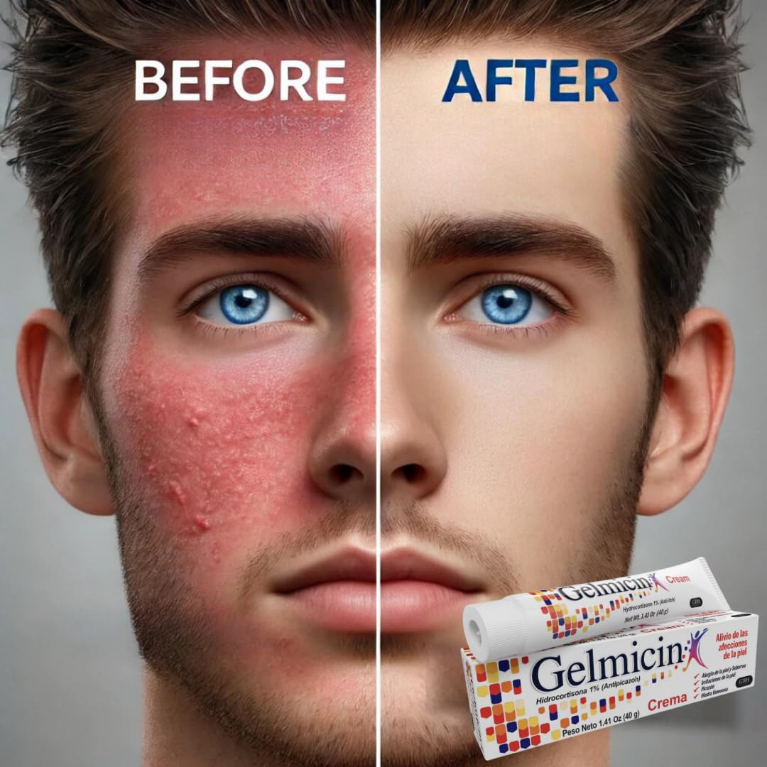 Gelmicin Hydrocortisone 1% - Anti-Itch Cream, Skin Rash, Skin Allergies, Eczema, Psoriasis - 1.41 oz Size (1)