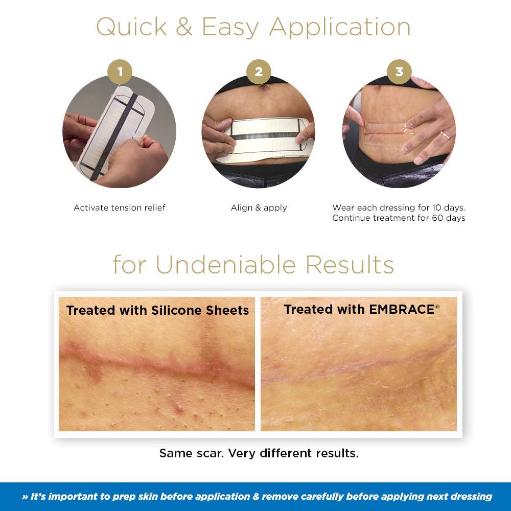 Embrace Active Scar Defense for New Scars, FDA-Cleared Silicone Scar Sheets, 4.7 Inch, Large, 30 Day Supply
