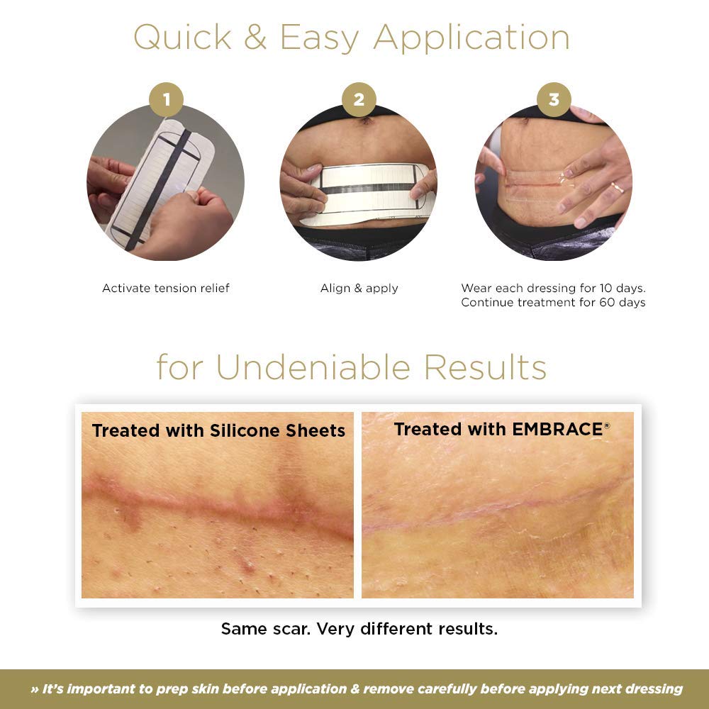 Embrace Active Scar Defense for New Scars, FDA-Cleared Silicone Scar Sheets, 6.3 Inch, X-Large, 30 Day Supply - Packaging May Va
