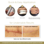 Embrace Active Scar Defense for New Scars, FDA-Cleared Silicone Scar Sheets, 6.3 Inch, X-Large, 30 Day Supply - Packaging May Va