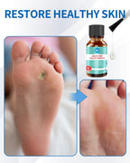 MQ Professional Corn & Callus Remover Liquid for Feet & Toes - Fast Acting for Corn Removal, Hard Skin & Dead Skin - Includes 15