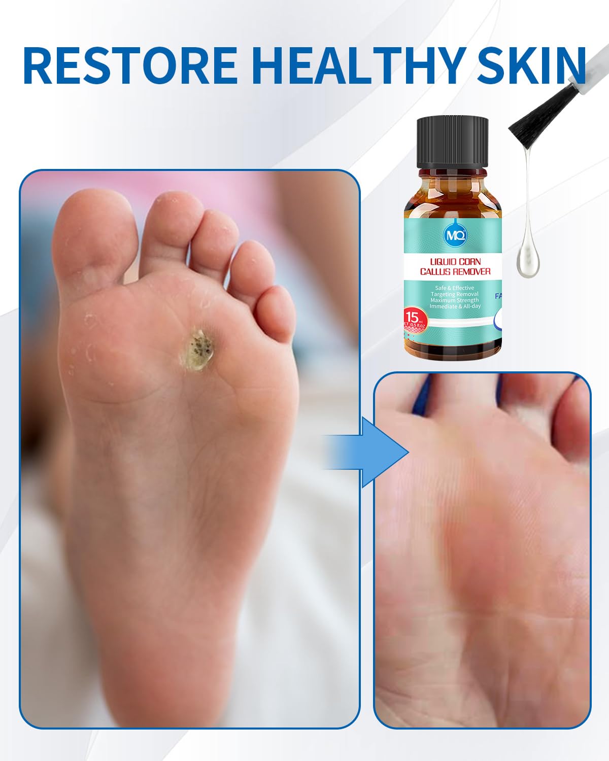 MQ Professional Corn & Callus Remover Liquid for Feet & Toes - Fast Acting for Corn Removal, Hard Skin & Dead Skin - Includes 15