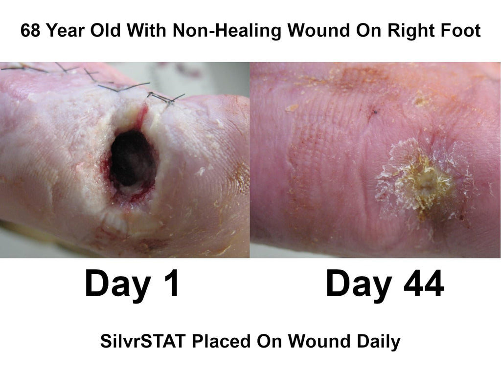 SilvrSTAT First Aid Kit Gel | 32 PPM Silver Healing Wound Dressing Solution | SilverSol Ag4O4 Particles | 3 oz