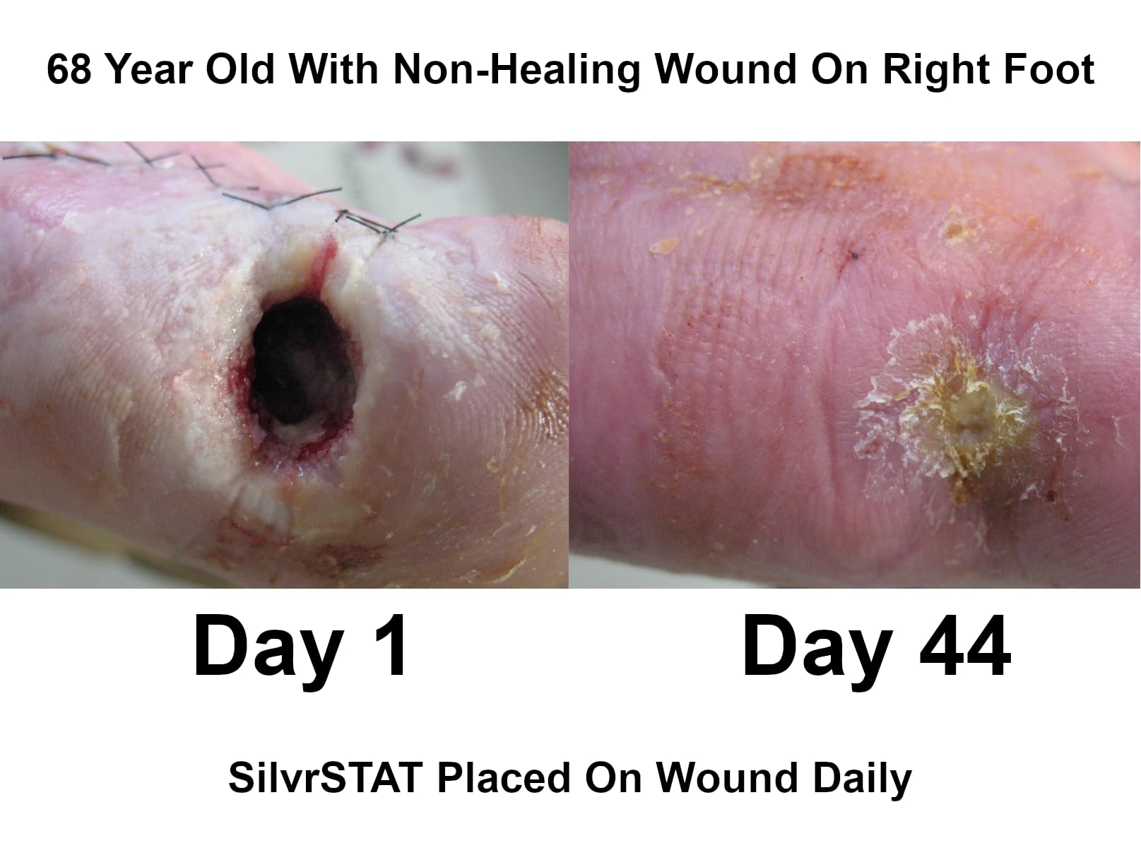 SilvrSTAT First Aid Kit Gel | 32 PPM Silver Healing Wound Dressing Solution | SilverSol Ag4O4 Particles | 3 oz
