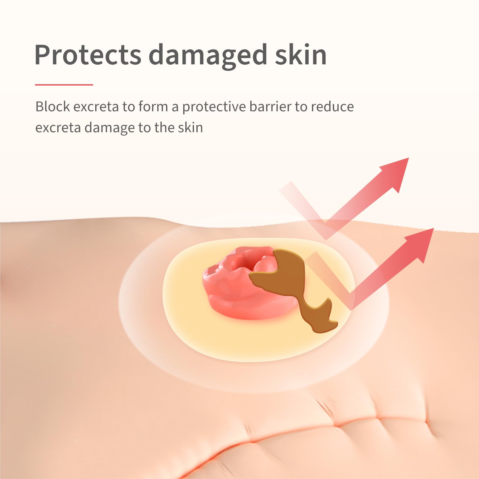 DERAYMI 10 Pack Moldable Ostomy Barrier Rings, 4mm Thickness Barrier Rings for Ostomy Bags, Sting-Free Hydrocolloid Ileostomy El