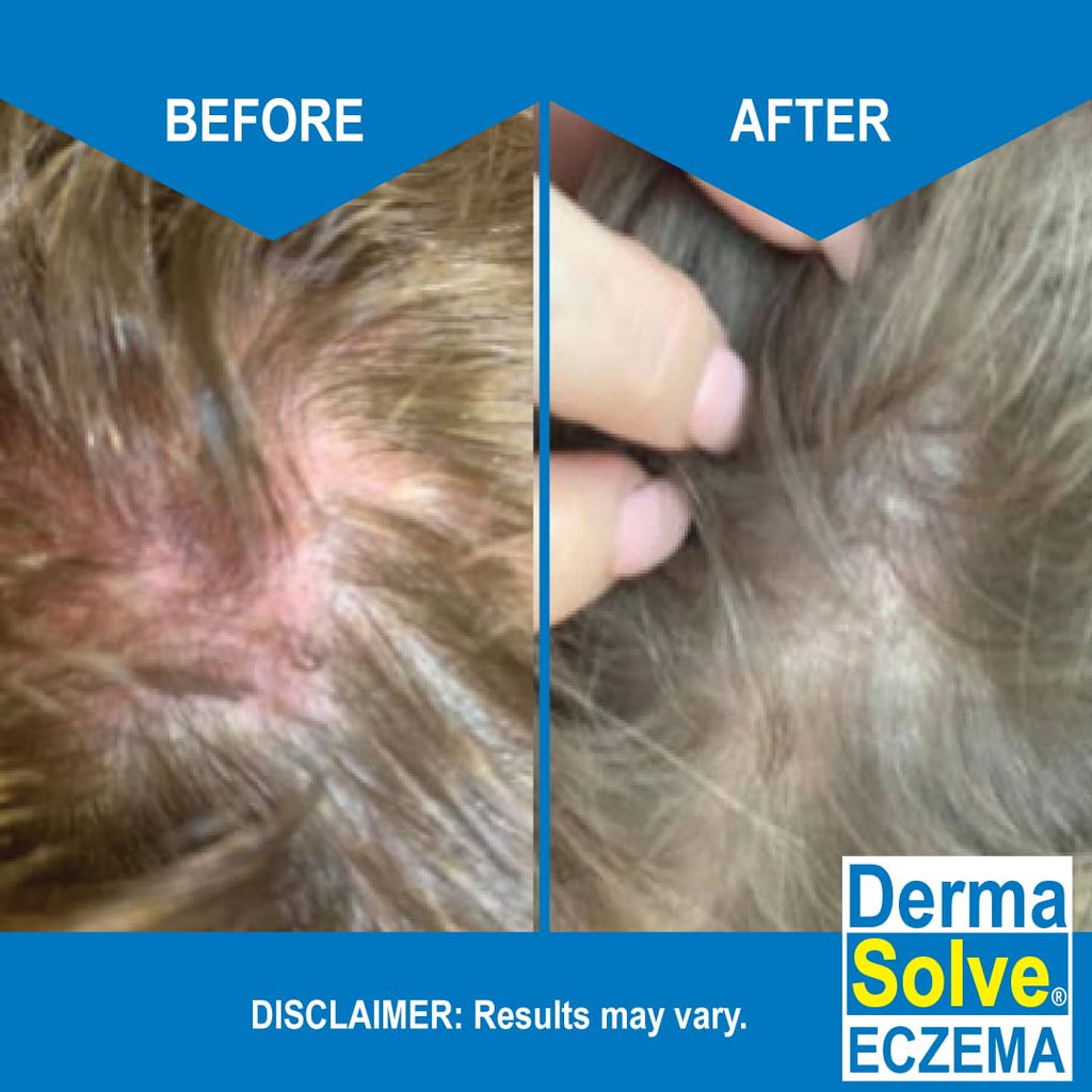 Dermasolve Eczema Relief Shampoo - Flare Control Scalp & Dandruff Free Therapy That Protects, Moisturizes, and Repairs Skin for