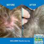 Dermasolve Eczema Relief Shampoo - Flare Control Scalp & Dandruff Free Therapy That Protects, Moisturizes, and Repairs Skin for