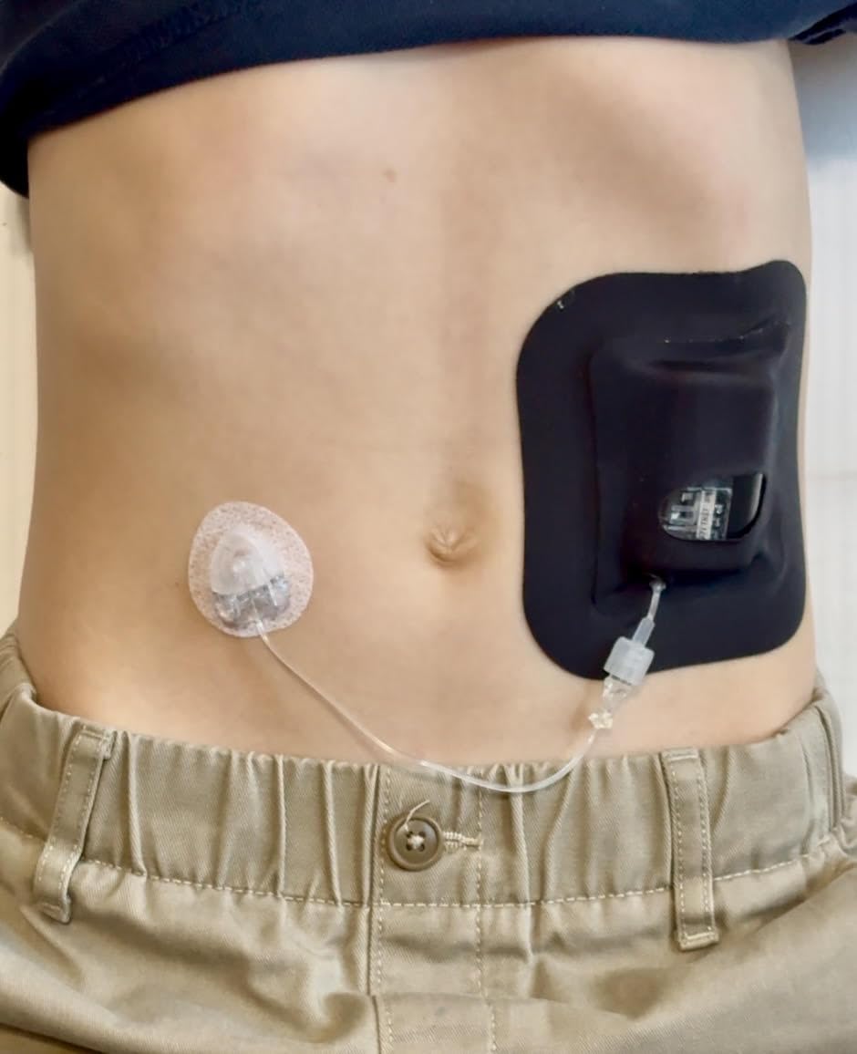 Glucomart Adhesive Pocket for Mobi (5 Count) - Maximum Strength Patches for Wearing Mobi Insulin Pump, Waterproof & Hypoallergen