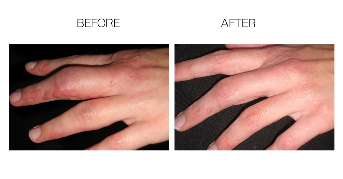 Scarfade silicone scar gel for scar removal, scar therapy - 30g Tube