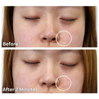 Dermaflage Scar Filler Kit - Golden Fair - Deep Scar Cover and Waterproof Concealer for Acne Scars Wrinkles, and Ice Pick Scars