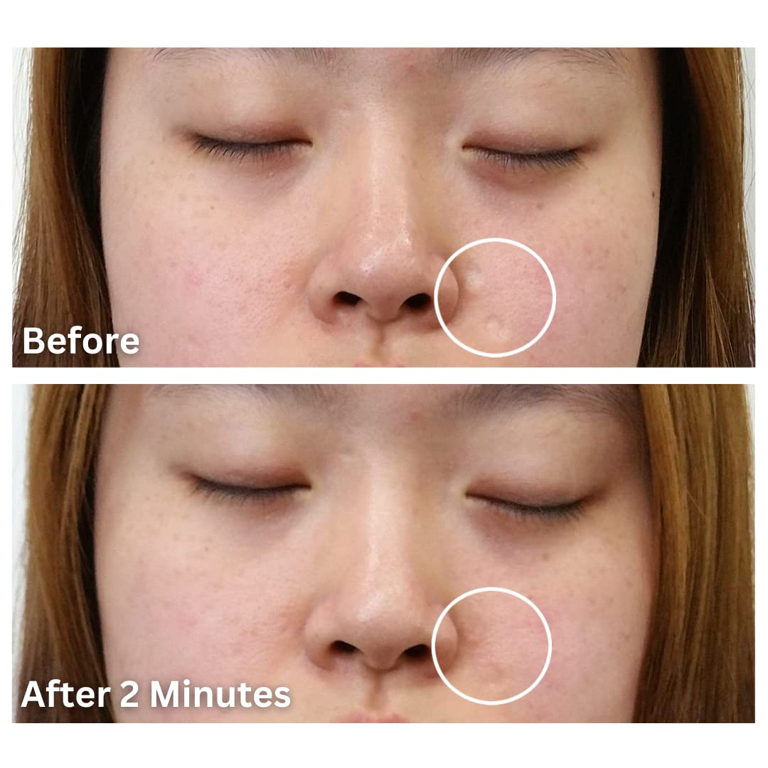 Dermaflage Scar Filler Kit - Golden Fair - Deep Scar Cover and Waterproof Concealer for Acne Scars Wrinkles, and Ice Pick Scars