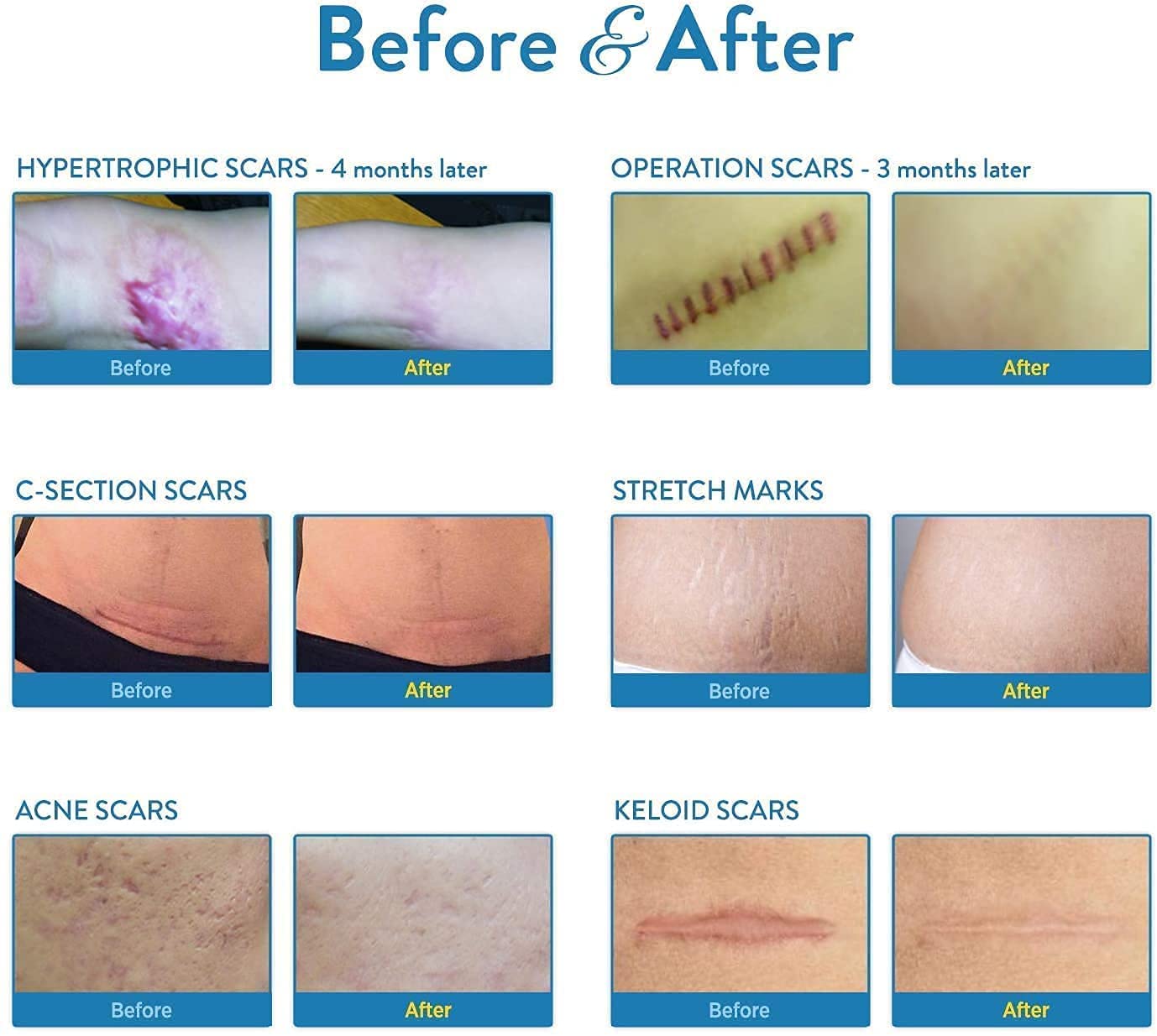 Aroamas Scar Professional Soft Silicone Scar Sheets Strips, Soften and Flattens Scars Resulting from Surgery, Injury, Burns, C-S