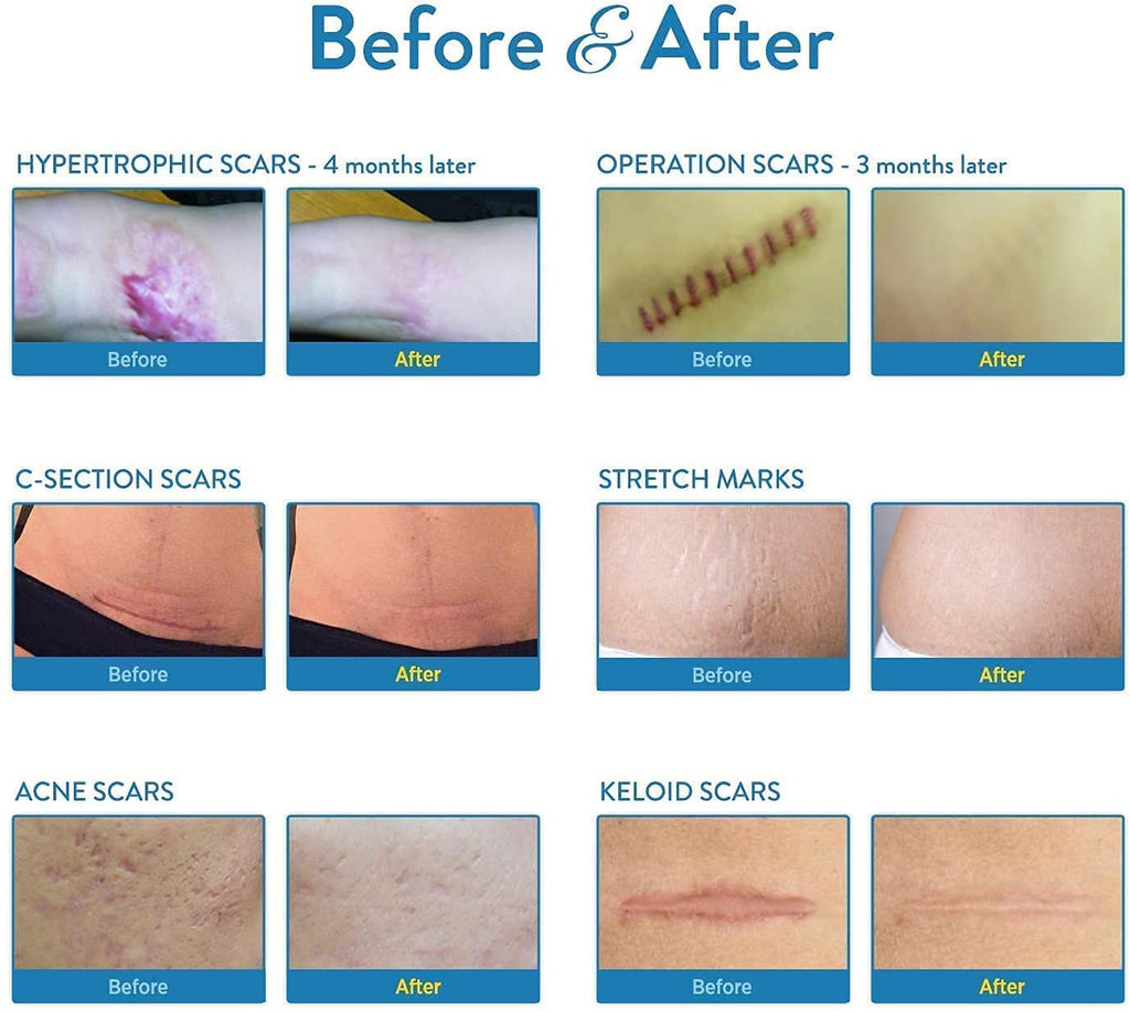 Aroamas Scar Professional Soft Silicone Scar Sheets Strips, Soften and Flattens Scars Resulting from Surgery, Injury, Burns, C-S