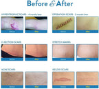 Aroamas Scar Professional Soft Silicone Scar Sheets Strips, Soften and Flattens Scars Resulting from Surgery, Injury, Burns, C-S