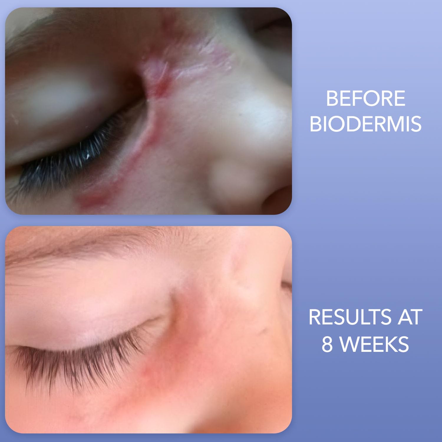 Biodermis Pro-SIL Silicone Scar Gel Stick - Scar Reduction Care for Surgical, Acne, Trauma Scars & Burns - Safe for Children, Me
