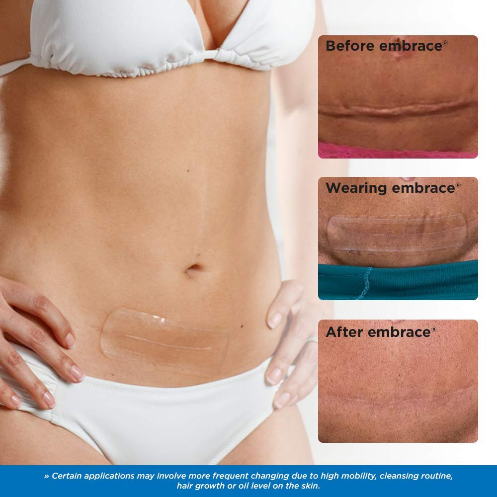 Embrace Active Scar Defense for New Scars, FDA-Cleared Silicone Scar Sheets, 4.7 Inch, Large, 30 Day Supply