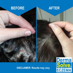 Dermasolve Eczema Relief Shampoo - Flare Control Scalp & Dandruff Free Therapy That Protects, Moisturizes, and Repairs Skin for
