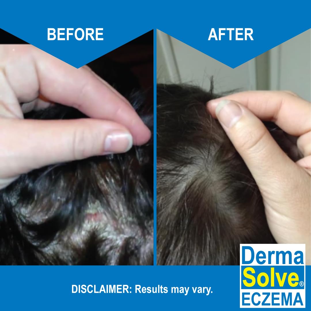 Eczema Shampoo & Conditioner (Combo Pack) - Flare Control Scalp & flake Relief Therapy that Protects, Moisturizes, and Repairs S