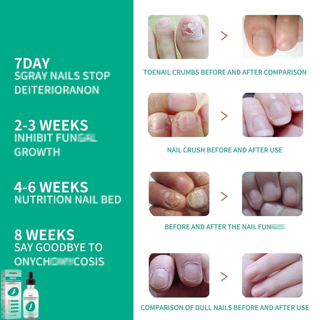 Kerassentials Nails Nutrient Oil,Kerassentials Toenail Oil,Nail Repair Solution,Nail Renewal Liquid For Damaged & Discoloration