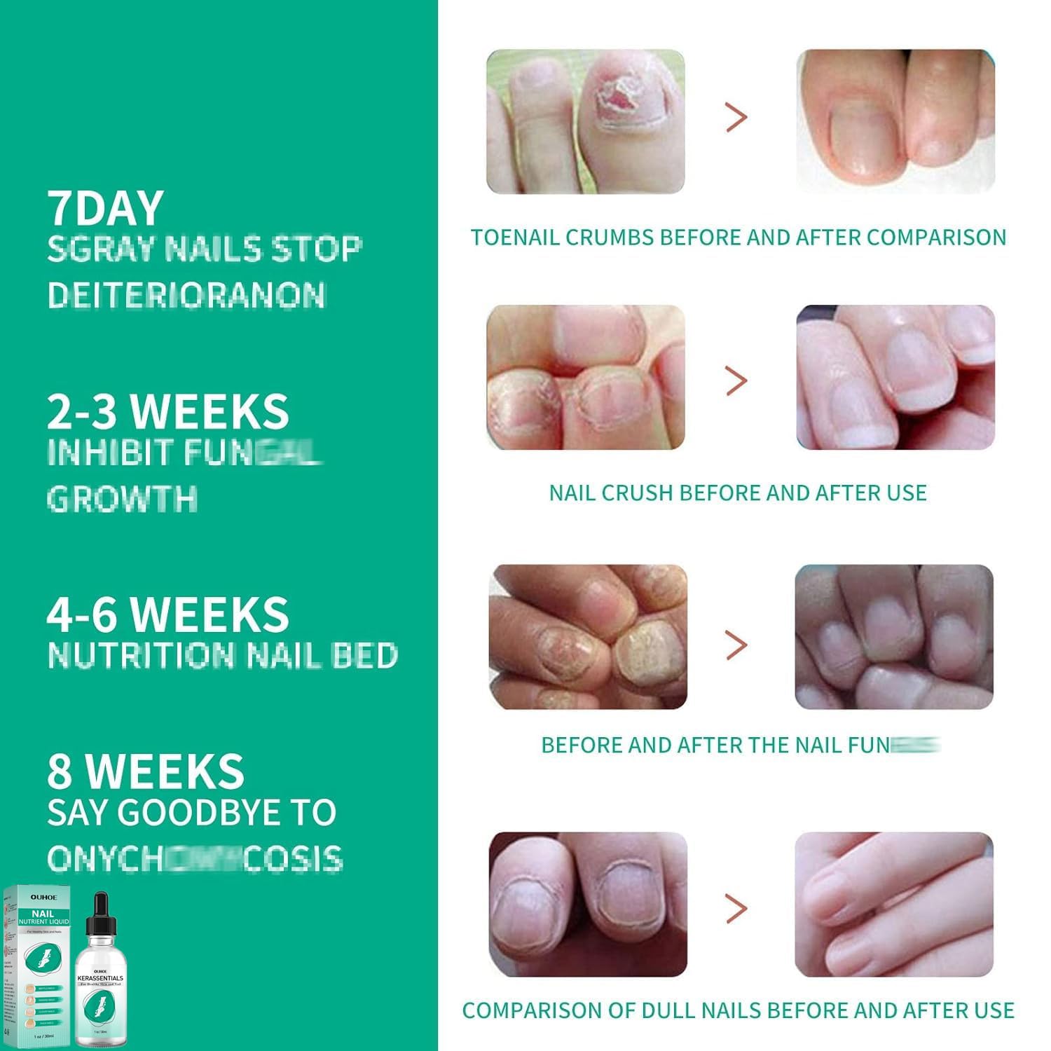Kerassentials Nails Nutrient Oil,Kerassentials Toenail Oil,Nail Repair Solution,Nail Renewal Liquid For Damaged & Discoloration