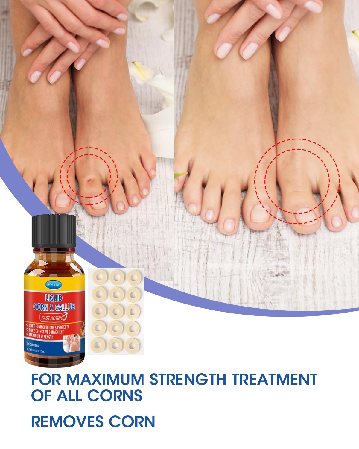 MYMULIKE 30ML Liquid for Corn, Corn Removers for Toes,Corn Removal for Feet Fast Acting Liquid, Liquid for Plantar,Corn Remover
