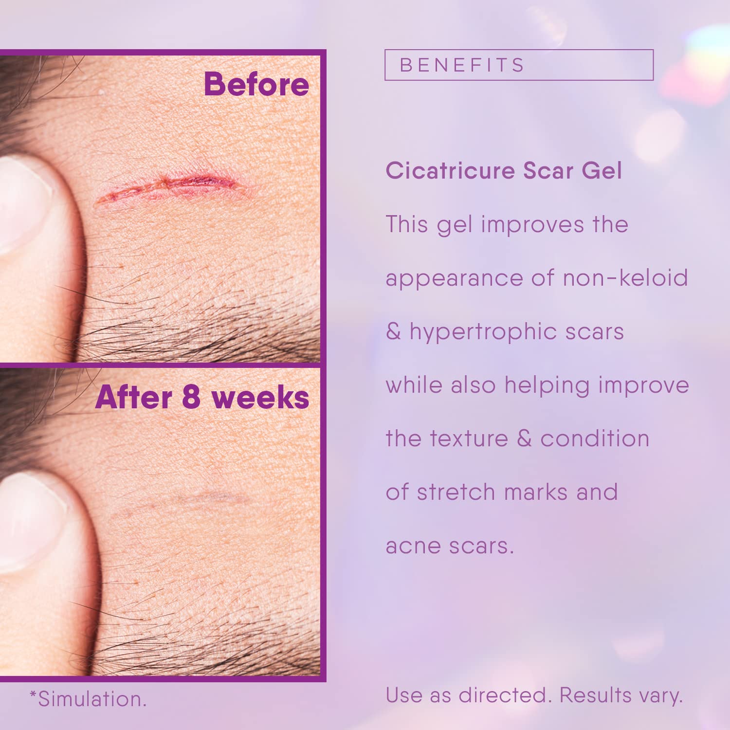 Cicatricure Face & Body Advanced Scar Gel, Scar Treatment for Old & New Scars, Fades Stretch Marks Away, Surgical Scars, Injurie
