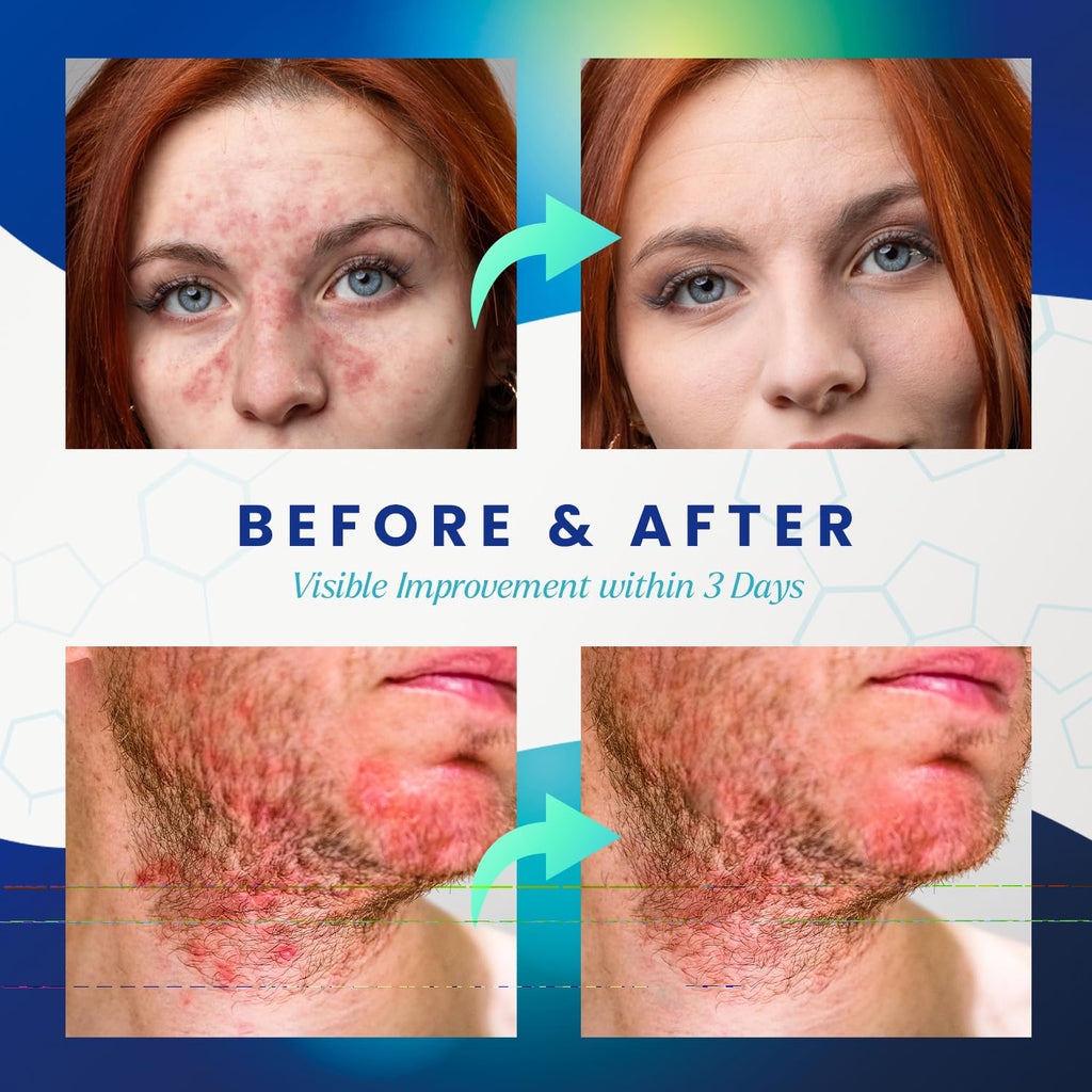 Seborrheic Dermatitis Psoriasis Cream: Antifungal Treatment - Traditional Herbal Infused - Relief for Flaking Irritated Scalp Sk