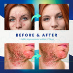 Seborrheic Dermatitis Psoriasis Cream: Antifungal Treatment - Traditional Herbal Infused - Relief for Flaking Irritated Scalp Sk
