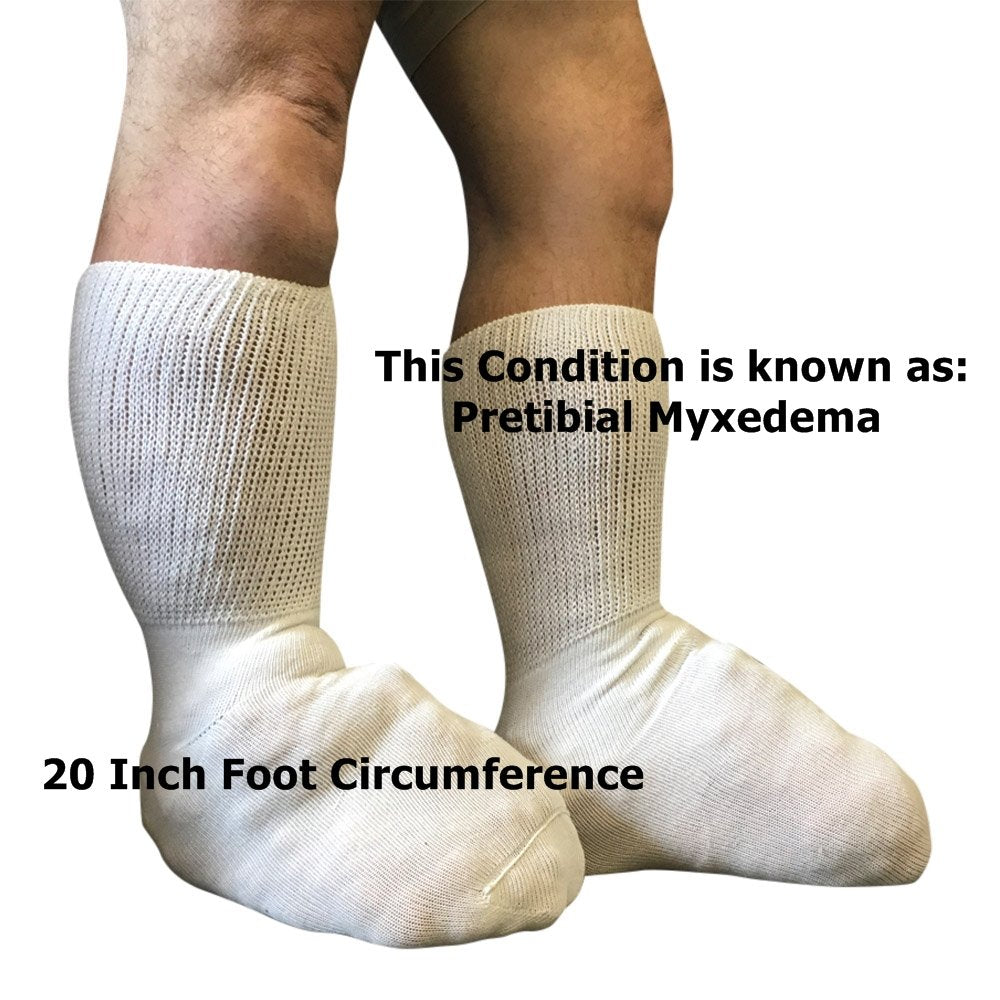 Bariatric Sock for Extreme Lymphedema Calf stretches to 30'' (Black)
