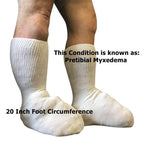 Bariatric Sock for Extreme Lymphedema Calf stretches to 30'' (Black)