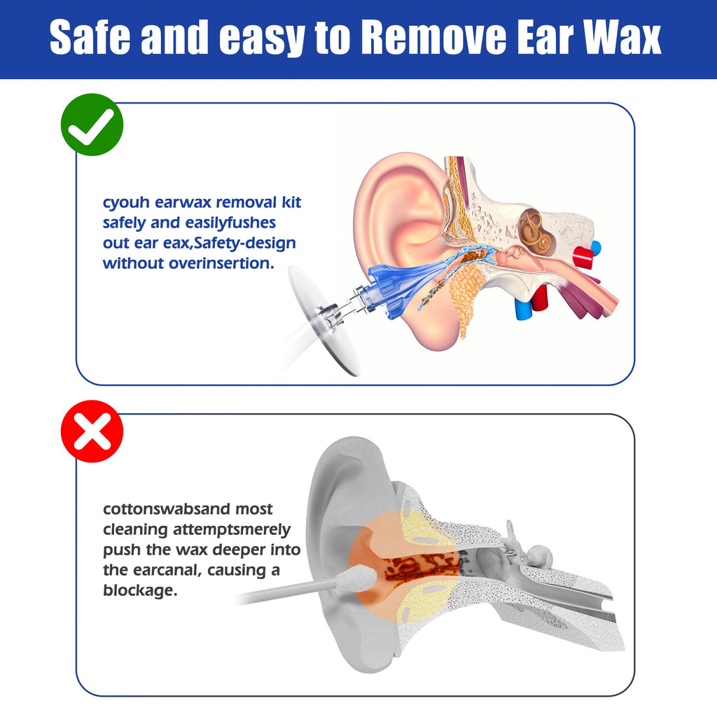 CYOUH Ear Wax Remover, Ear Cleaner, Ear Cleaning Kit, Manual Ear Wash System, Safe and Effective for Cleaning Earwax Deposits(Sa