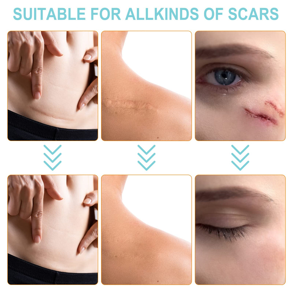 Silicone Scar Sheets (1.6    x 150   -3.8M), Medical Grade Soft Silicone Scar Tape, Strips, Roll - Keloid, C-Section, Surgical,