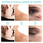 Silicone Scar Sheets (1.6    x 150   -3.8M), Medical Grade Soft Silicone Scar Tape, Strips, Roll - Keloid, C-Section, Surgical,