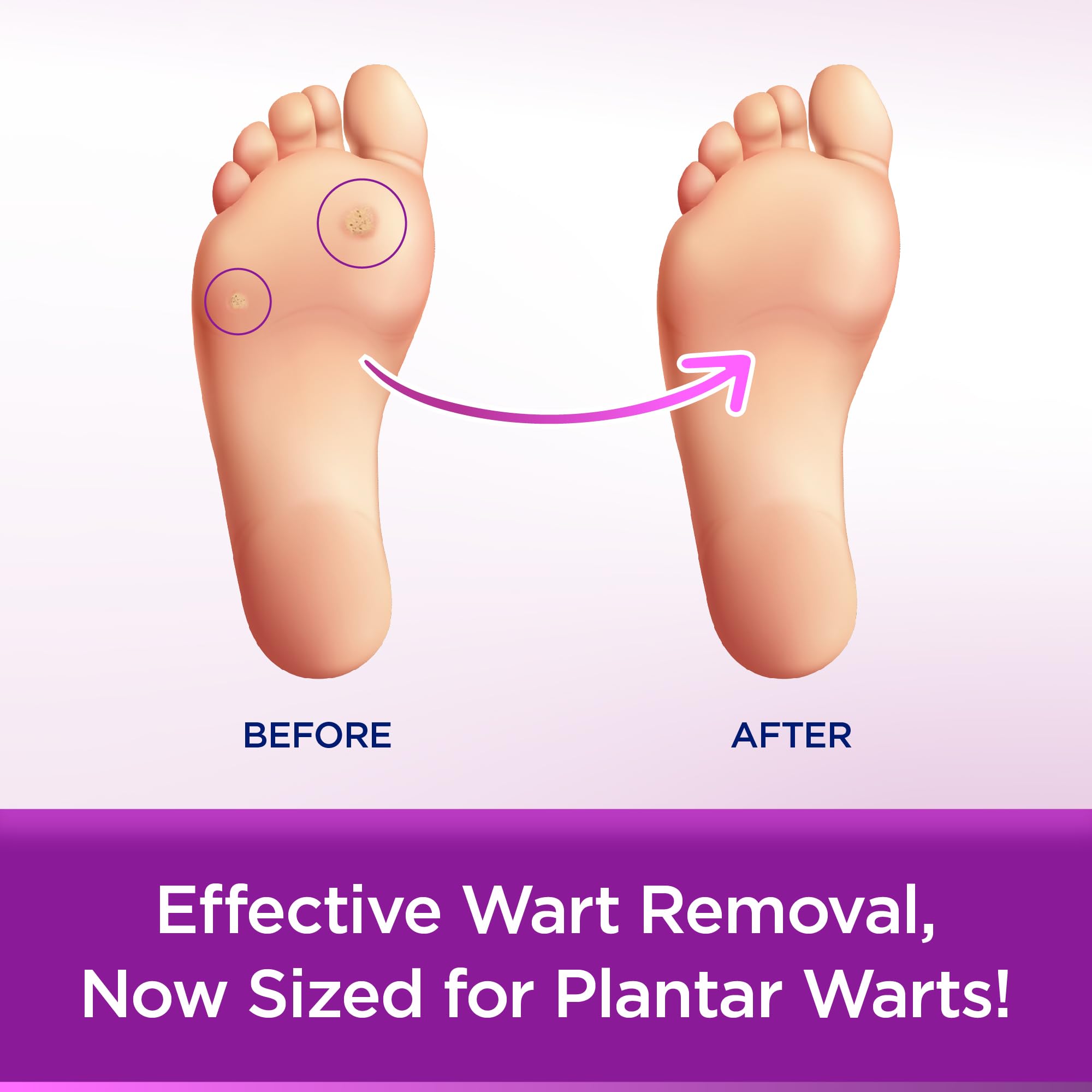 WartStick Plantar Maximum Strength Salicylic Acid Solid-Stick Plantar Wart Remover, 0.34 Oz