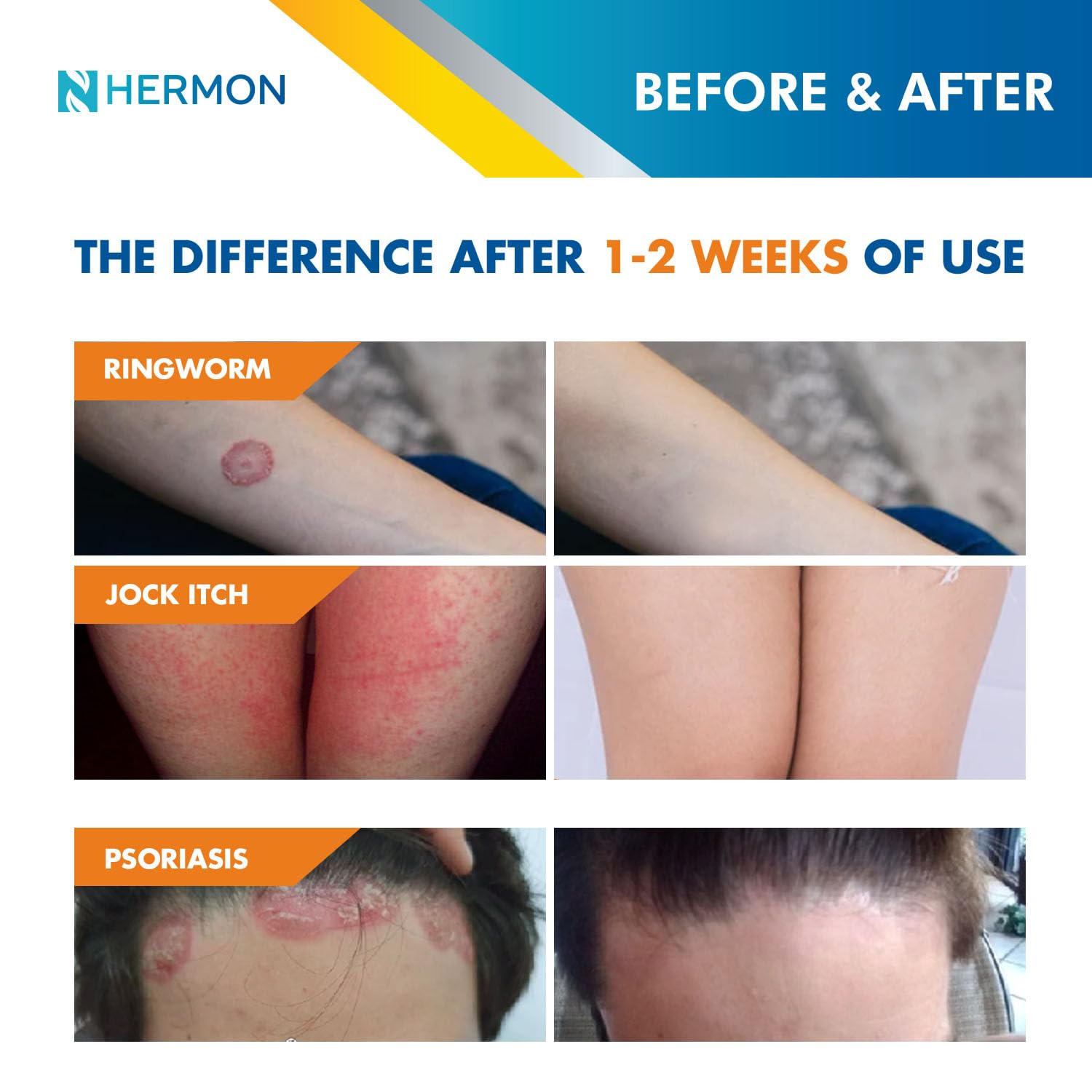 Hermon Powerful Antifungal Ringworm Cream - Effective Treatment for Stubborn Ringworm, Jock Itch, Eczema, Tinea Versicolor, Athl