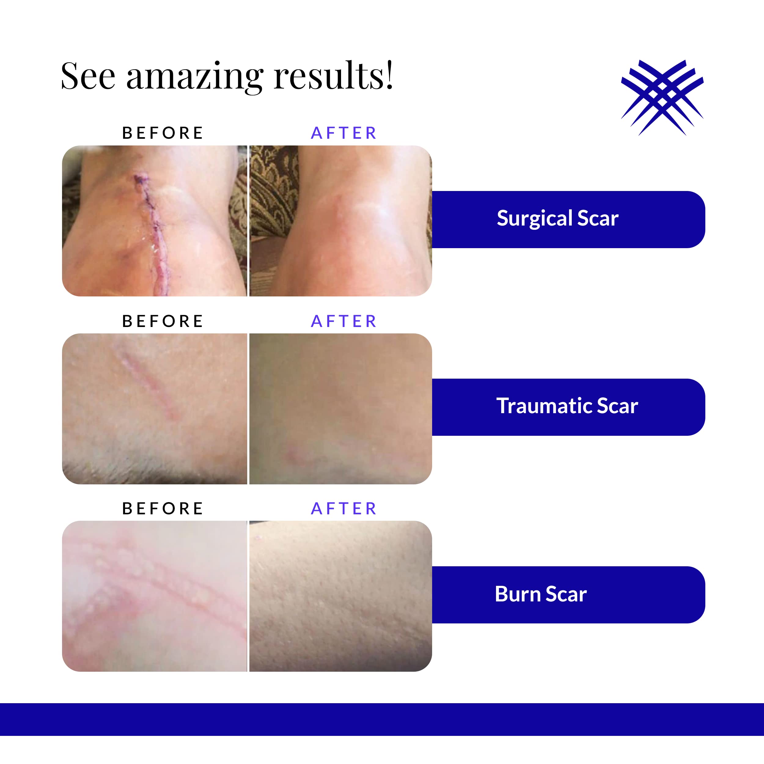 Rejuvaskin Rejuvasil Silicone Scar Gel - Scar Treatment for Surgical Scars for Face, Body, Burn, Keloids, and Acne Scar - Silico